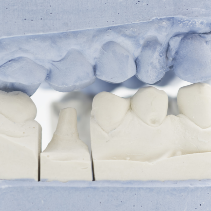 噛み合わせ治療イメージ